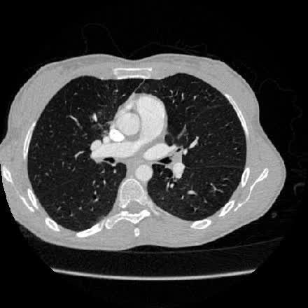 Axial CTA chest slice at the pulmonary artery, round ascending aorta centered