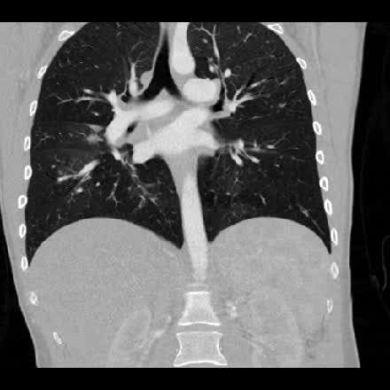 Coronal CTA chest reformat