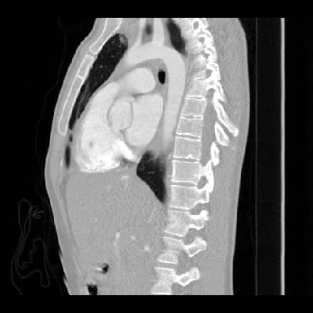 Sagittal CTA chest reformat with the thoracic spine